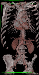 Right Internal Iliac Artery Aneurysm - CTisus CT Scan