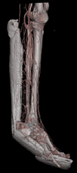 CTA Leg in Cast - CTisus CT Scan