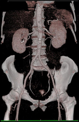 Stenosis of SMA Origin - CTisus CT Scan