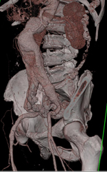 Aortic Aneurysm - CTisus CT Scan