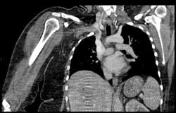 Clot in Innominate Vein - CTisus CT Scan