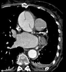 Type A Dissection - CTisus CT Scan