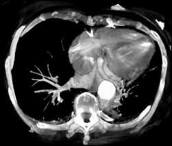 Type A Dissection - CTisus CT Scan