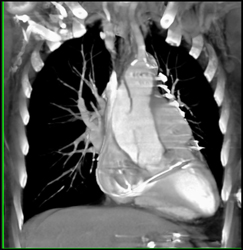 Type A Dissection - CTisus CT Scan