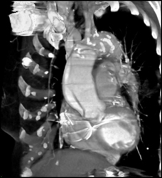 Type A Dissection - CTisus CT Scan