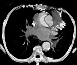 Type A Dissection - CTisus CT Scan