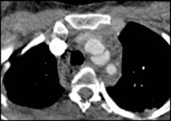 Traumatic Aortic Dissection With Negative Angiogram - CTisus CT Scan