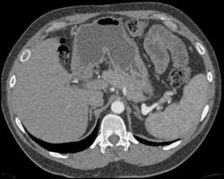 Splenic Artery Aneurysm - CTisus CT Scan