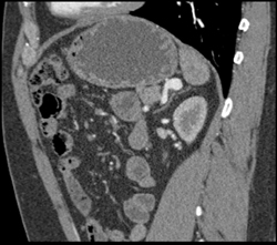 Splenic Artery Aneurysm - CTisus CT Scan