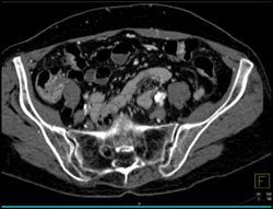 Diseased External Iliac Arteries - CTisus CT Scan