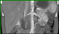 IMA Simulates An Accessory Renal Artery - CTisus CT Scan