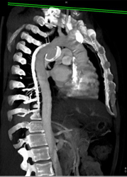 Ductus Aneurysm - CTisus CT Scan