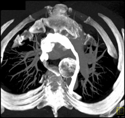 Ductus Aneurysm - CTisus CT Scan