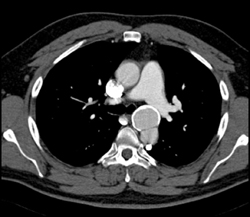 Ductus Aneurysm - CTisus CT Scan