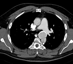 Ductus Aneurysm - CTisus CT Scan