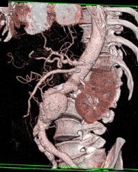 Aortic Aneurysm - CTisus CT Scan