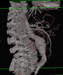 Aortic Aneurysm - CTisus CT Scan