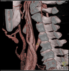 Dilated Internal Carotid Artery - CTisus CT Scan