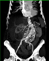 Aortic Aneurysm With Calcified Plaque - CTisus CT Scan