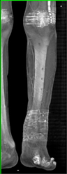 Runoff Study Post Plates/screws Removal - CTisus CT Scan