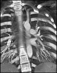 Focal Dissection S/P MVA - CTisus CT Scan