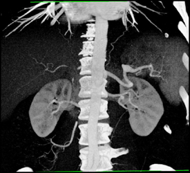 Splenic Artery Aneurysm - CTisus CT Scan