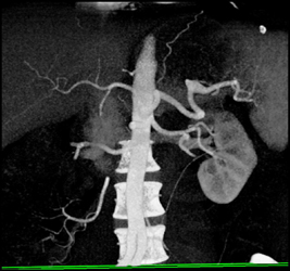 Splenic Artery Aneurysm - CTisus CT Scan