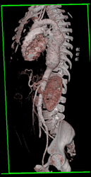 Descending Thoracic Aneurysm - CTisus CT Scan