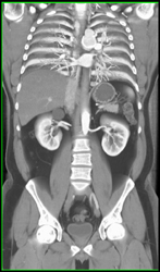 Ductus Aneurysm - CTisus CT Scan