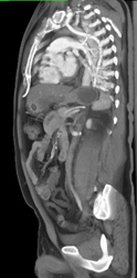 Superior Intercostal Vein - CTisus CT Scan