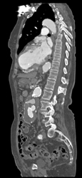 Aortic Aneurysm Repair With Grafts - CTisus CT Scan