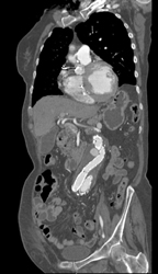 Aortic Endoleak From Graft Leak - CTisus CT Scan