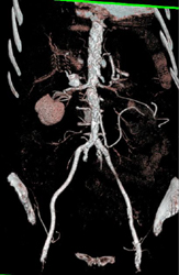 Atherosclerotic Disease Aorta - CTisus CT Scan