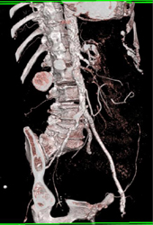 Diseased Right Common Iliac Artery - CTisus CT Scan