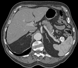 Splenic Artery Aneurysm - CTisus CT Scan