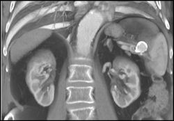 Splenic Artery Aneurysm - CTisus CT Scan