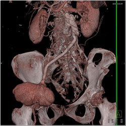 Femoral Artery Pseudoaneurysm and Occluded Limb of Right Iliac Graft - CTisus CT Scan