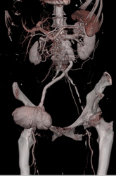 Pseudoaneurysm Right Groin - CTisus CT Scan