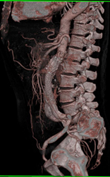 Endoleak - CTisus CT Scan