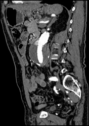 Endoleak - CTisus CT Scan