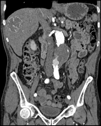 Endoleak - CTisus CT Scan