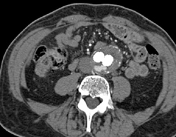 Endoleak - CTisus CT Scan