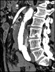 Endoleak - CTisus CT Scan