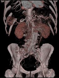 Aortic Stent Graft - CTisus CT Scan