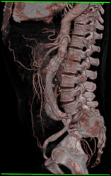 Endoleak - CTisus CT Scan