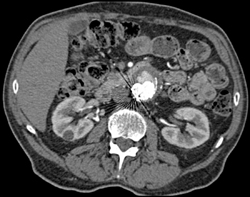 Endoleak - CTisus CT Scan