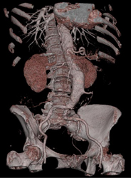 IMA Arises Off Aortic Aneurysm - CTisus CT Scan