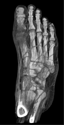 CTA of the Foot With Multiple Renderings - CTisus CT Scan