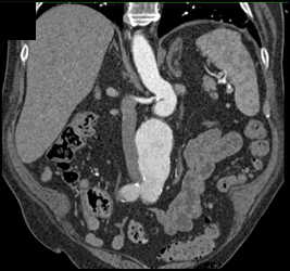 Aortic Aneurysm - CTisus CT Scan