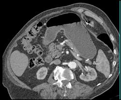 Aortic Aneurysm - CTisus CT Scan